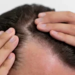 100-hair-restored-arthritis-drug-proves-efficacy-some-patients-report-hair-regrowth-in-trial