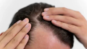 100-hair-restored-arthritis-drug-proves-efficacy-some-patients-report-hair-regrowth-in-trial